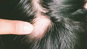 Saç dökülmesi ve çözümleri